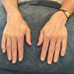 Restylane Skinbooster – hender og bryst